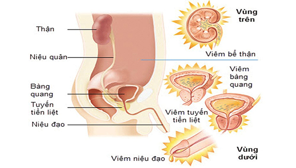 benh-nhiem-trung-duong-tieu Bệnh nhiễm trùng đường tiểu