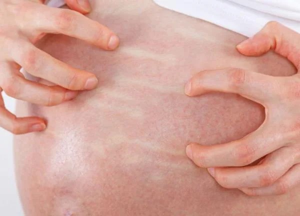 bi-ngua-khi-mang-thai-thang-cuoi Bị ngứa khi mang thai tháng cuối