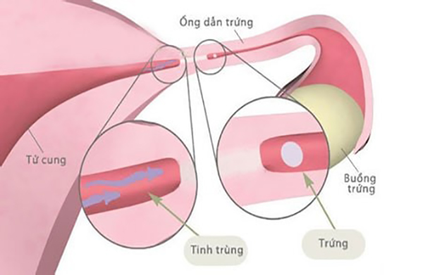 Biến chứng cua3 ứ dịch vòi trứng
