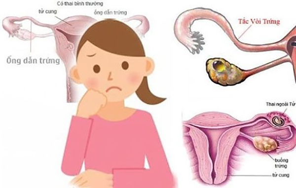 Biểu hiện tắc vòi trứng