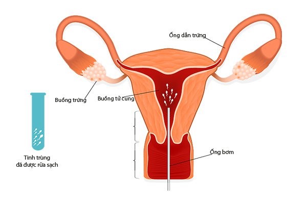 Bơm tinh trùng vào tử cung tại nhà