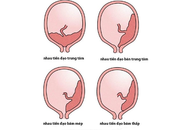cac-loai-nhau-tien-dao Các loại nhau tiền đạo