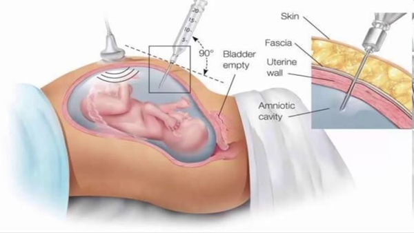 Thủ thuật chọc ối là gì?
