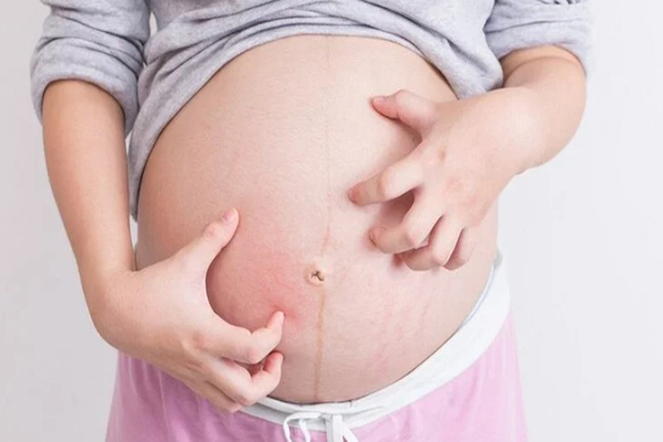 Da chuyển vàng kèm theo các cơn ngứa ngáy dai dẳng là dấu hiệu nhận biết thai lưu điển hình trong tam cá nguyệt thứ ba