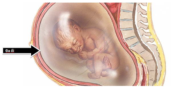 Đa ối có nguy hiểm không còn phụ thuộc vào lượng nước ối bị dư thừa