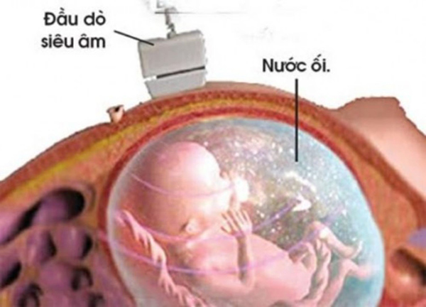 da-oi-la-gi Đa ối là gì chính là vấn đề mẹ nên tìm hiểu trước khi mang thai