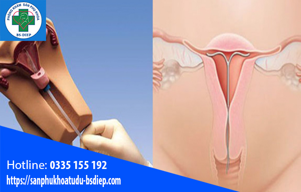 dat-vong-tranh-thai1-1 Dấu hiệu đặt vòng không hợp