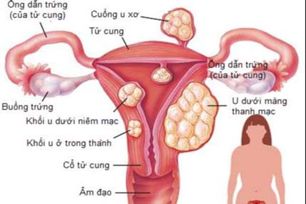 Dấu hiệu u nang tử cung