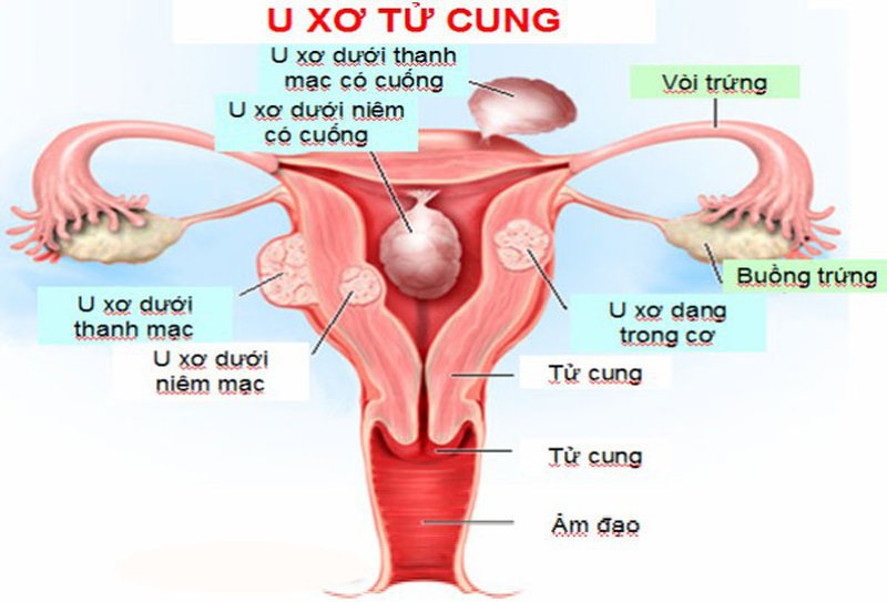 dau-hieu-u-xo-tu-cung-2 Dấu hiệu u xơ tử cung