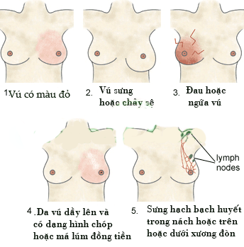 ung thư vú