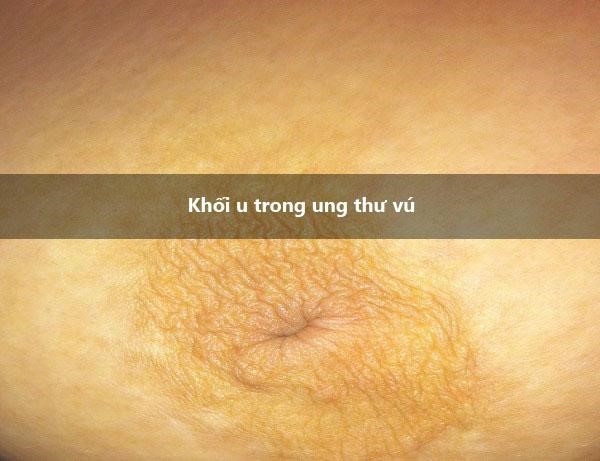 Khối u trong ung thư vú