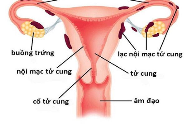 Lạc nội mạc tử cung có thai được không