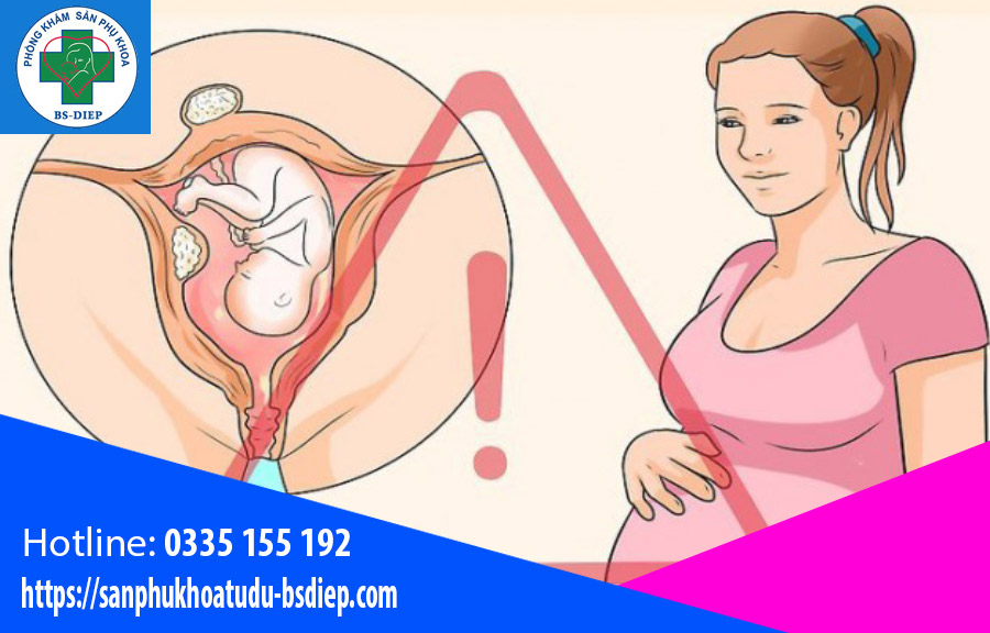 mang-thai-khi-bi-u-xo-tu-cung Mang thại bị u xơ tử cung