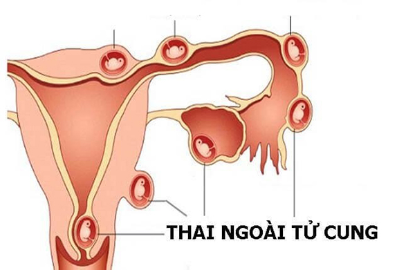 mang-thai-ngoai-tu-cung Mang thai ngoài tử cung