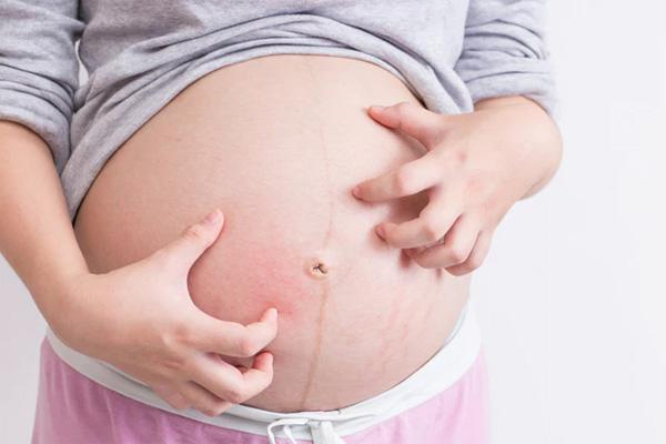 me-bau-bi0ngua-toan-than Mẹ bầu bị ngứa toàn thân