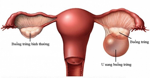 Liệu siêu âm có phát hiện u nang buồng trứng?