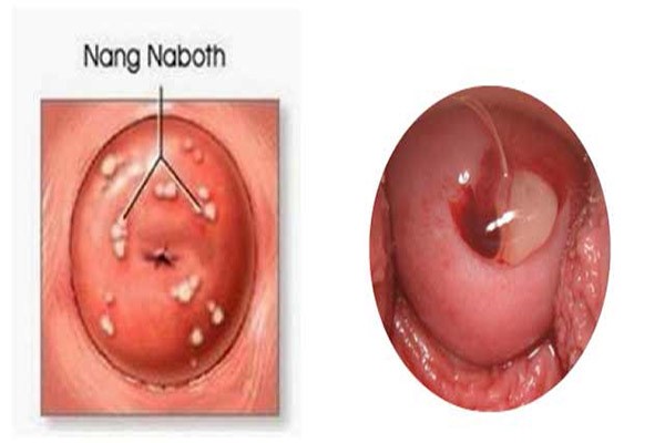 Nang Naboth chủ yếu ảnh hưởng tới khả năng mang thai và cảm xúc thăng hoa khi quan hệ tình dục