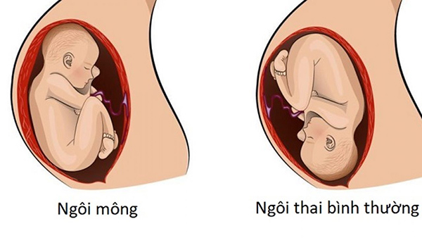 Ngôi thai