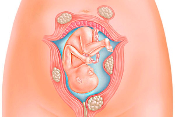 Nhân xơ tử cung có nguy hiểm không