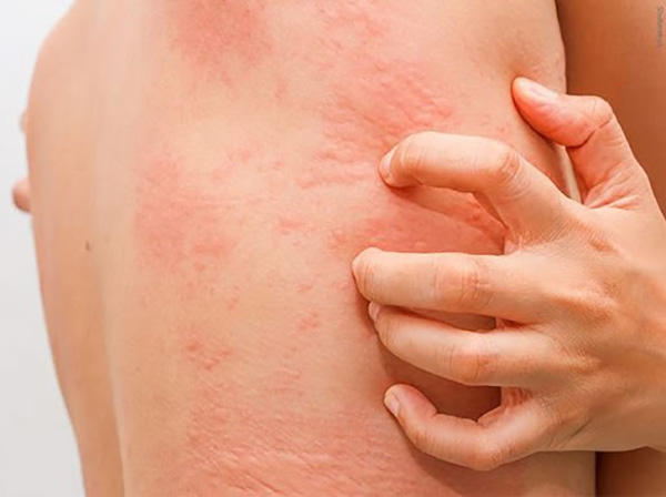 Mẹ bỉm rất dễ bị nổi mề đay sau sinh
