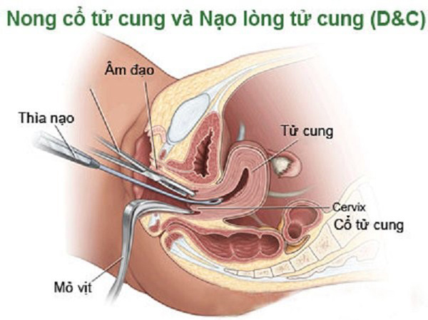 Nong cổ tử cung