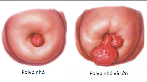 poluy-co-tu-cung Polyp cổ tử cung