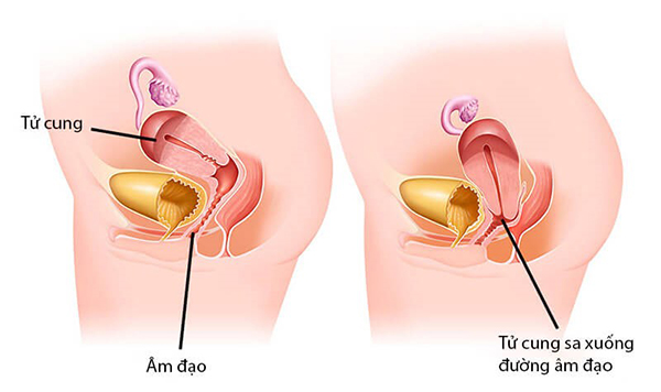 Sa cổ tử cung sau sinh