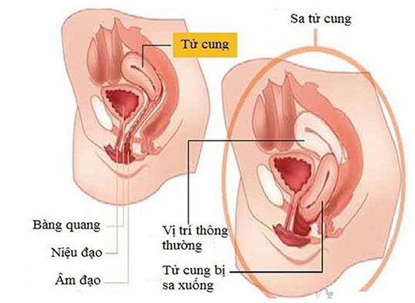 sa-dinh-duc Sa sinh dục