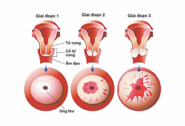 Ung thư cổ tử cung