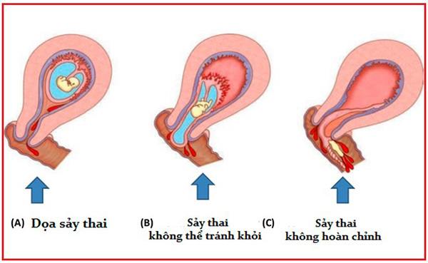 Sảy thai là gì