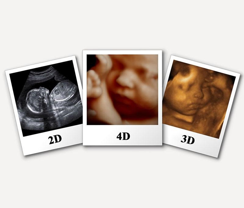 Siêu âm 3D