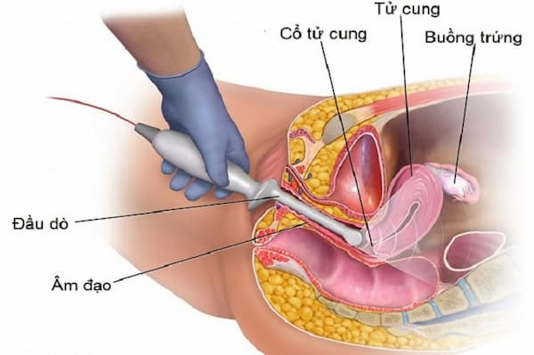 Siêu âm đầu dò