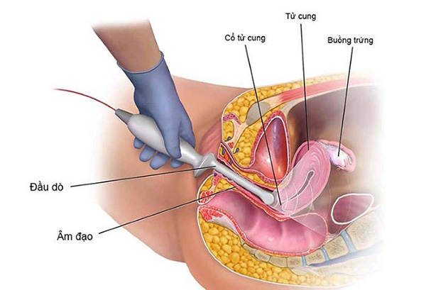 Siêu âm đầu dò âm đạo