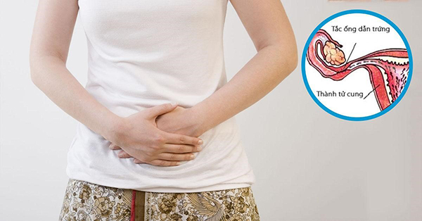 Ống dẫn trứng bị tắc gây ra nhiều hệ lụy, đặc biệt là chức năng sinh sản