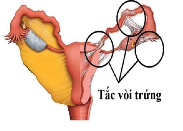 Tắc vòi trứng có kinh nguyệt không