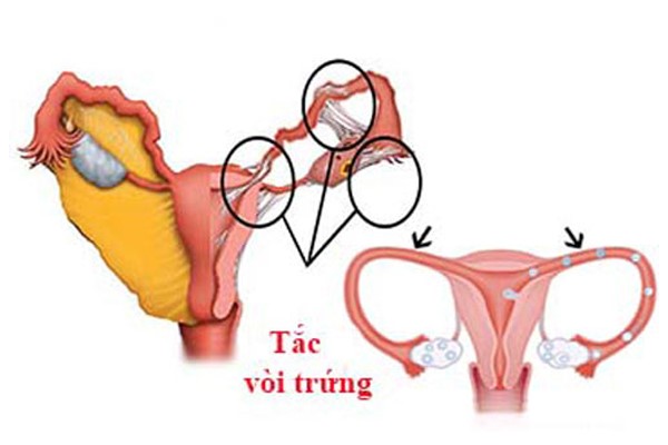 Tắc vòi trứng