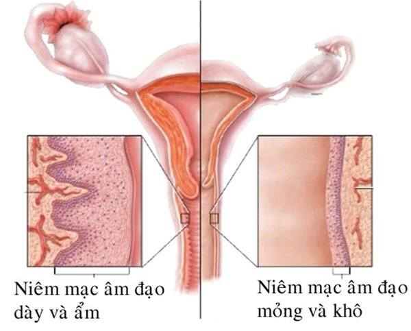 Teo âm đạo