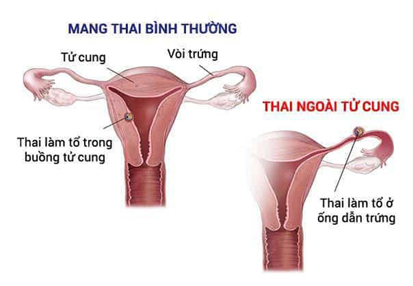 Tại sao thử thai 2 vạch như thai chưa vào tử cung?