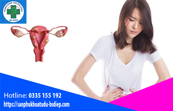 trieu-chung-u-xo-tu-cung Triệu chứng u xơ tử cung