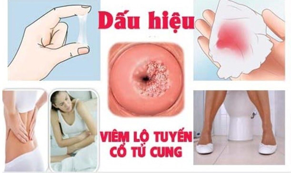 Triệu chứng viêm lộ tuyến cổ tử cung