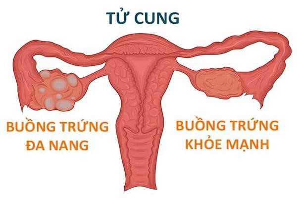 U nang buồng trứng ác tính