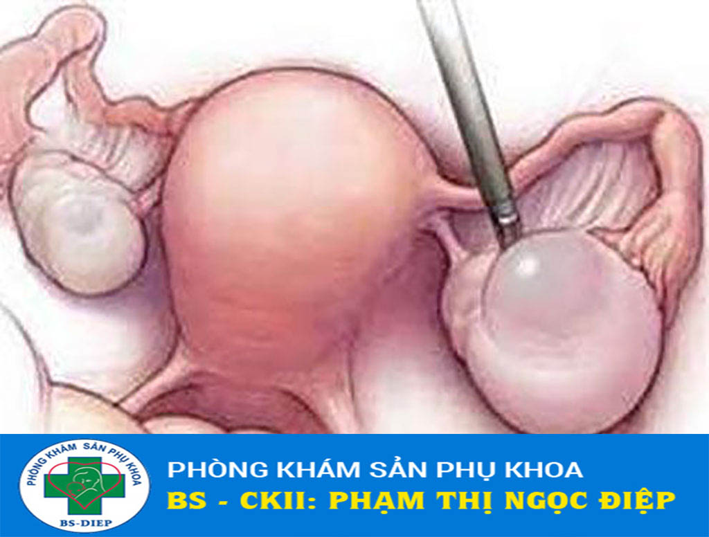 U nang buồng trứng