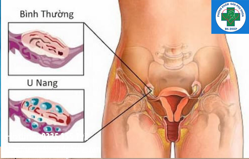 U nang buồng trứng trái có mang thai được không