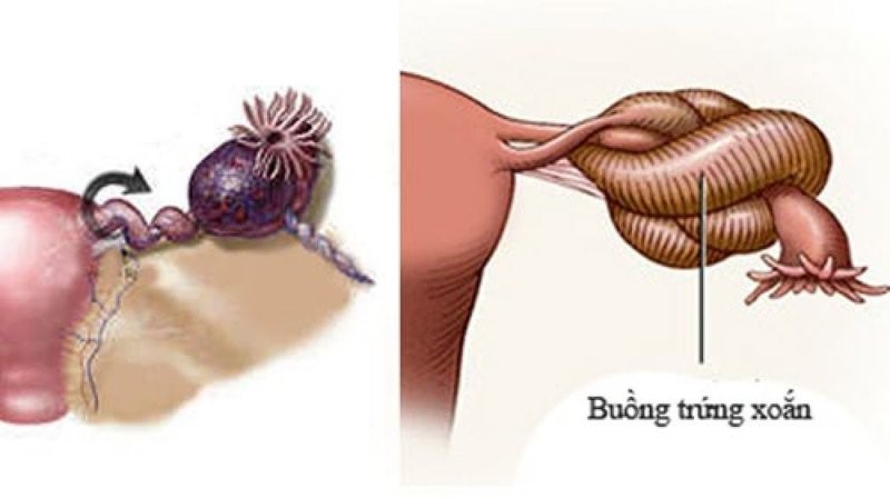 u-nang-buong-trung-xoan U nang buồng trứng xoắn