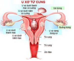 U xơ tử cung