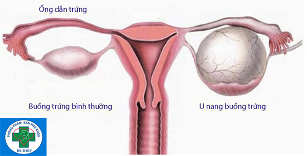 U nang buồng trứng phải