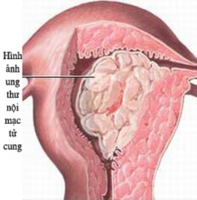 Ung thư nối mạc tử cung