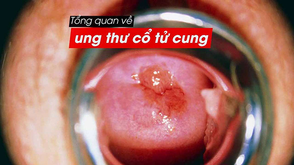 Ung thư tử cung