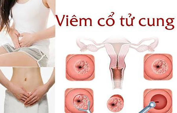 Viêm cổ tử cung
