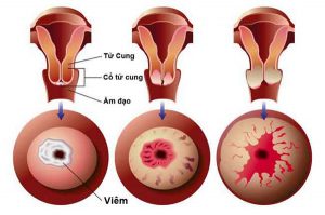 Viêm lộ tuyến cổ tử cung
